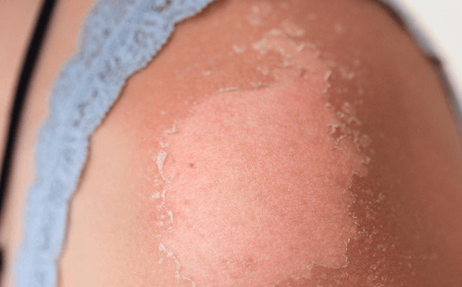 Cháy nắng gây nguy hiểm cho làn da